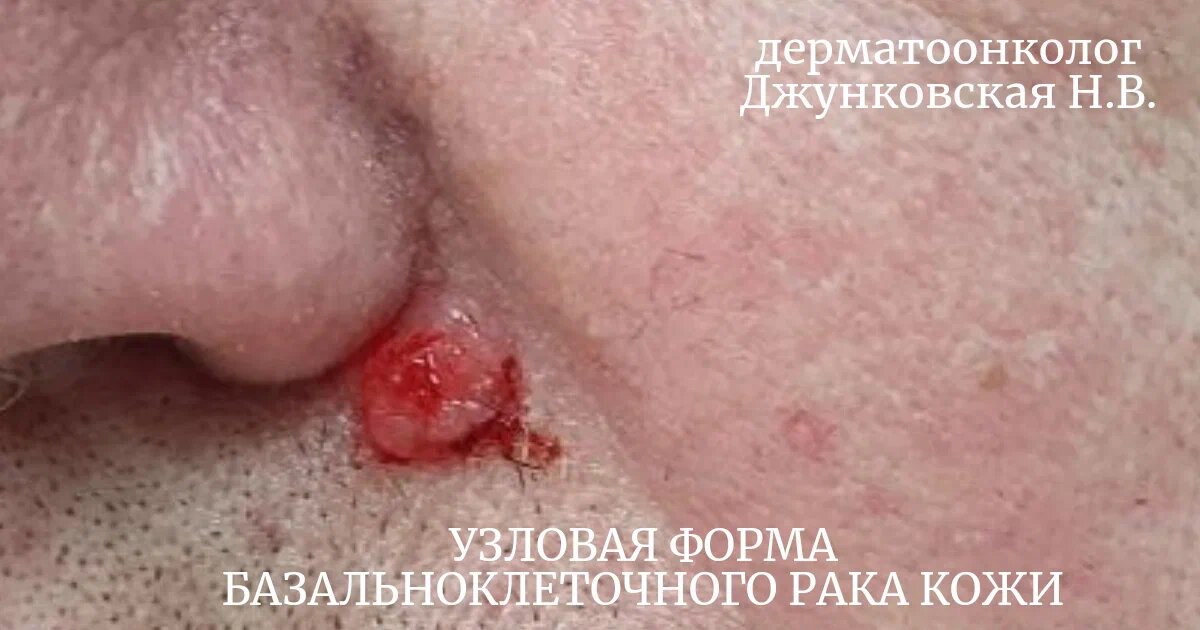 пациент обратился для эстетического удаления родинки, не подозревая, что это рак