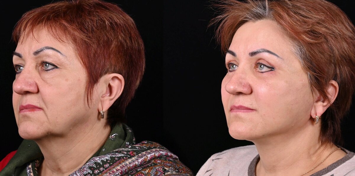 Проведен комплекс омолаживающих операций, включающий подтяжку лица SMAS в модификации МАКС лифт, пластика верхних век и заполнение подглазничной области липофилингом. Фото до и после. Фото с сайта хирурга Д.Р. Гришкяна. Имеются противопоказания, требуется консультация специалиста