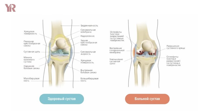 Почему болят колени при сгибании и ходьбе? Причина боли в коленном суставе