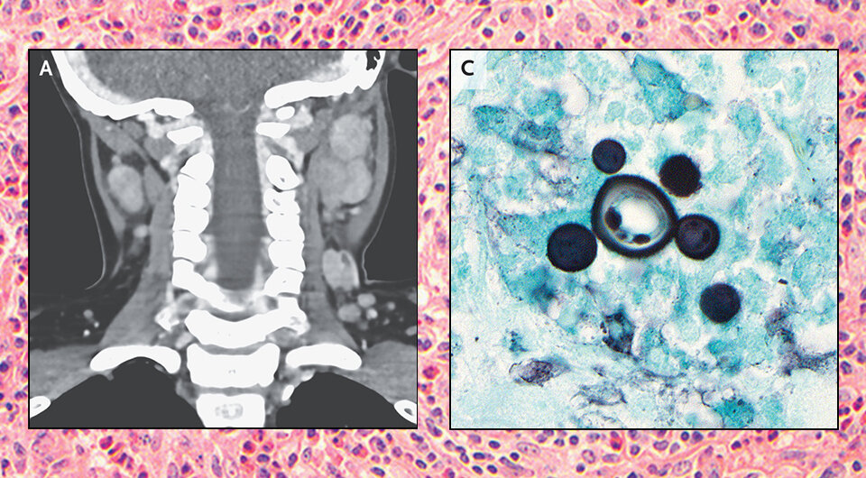   N + 1; Zemplen Pataki, Monika Pilichowska / NEJM, 2024