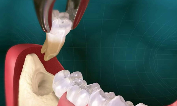 беременные в стоматологии. кариес зубов при беременности. беременная у стомотолог. можно вырвать зуб при беременности. можно ли беременным удалять зубы.