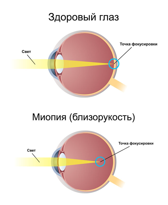 Сколько привыкать к очкам