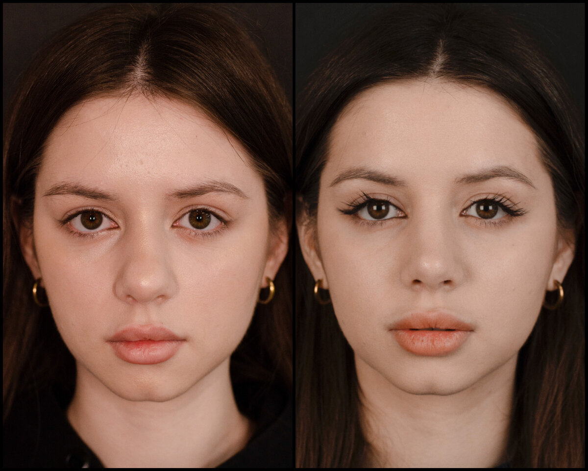 аганесов пластический хирург ринопластика. ольга шемонаева ринопластика. ринопластика желтиков. ринопластика хирург. марина лебедева ринопластика.