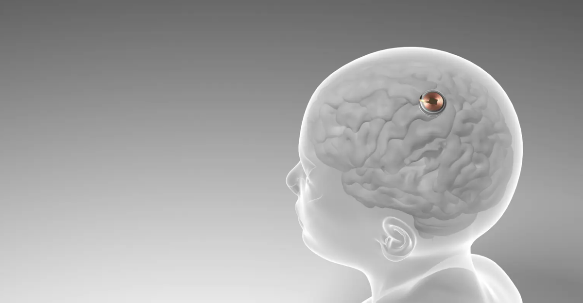 Neuralink 2022. Мозговой чип. Имплант Neuralink мозговой. Neuralink чипы в мозг.