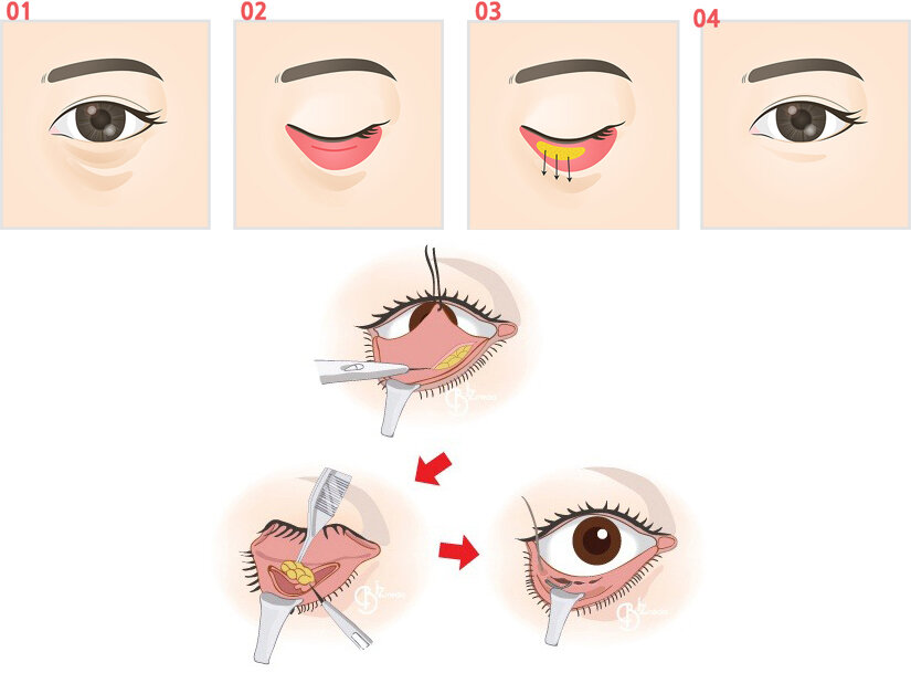 Разрез, как правило, делают на 1мм выше складки нижнего века.