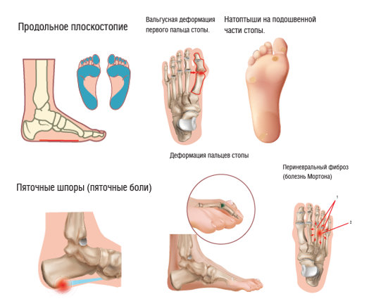 Ортопедические стельки при поперечном плоскостопии