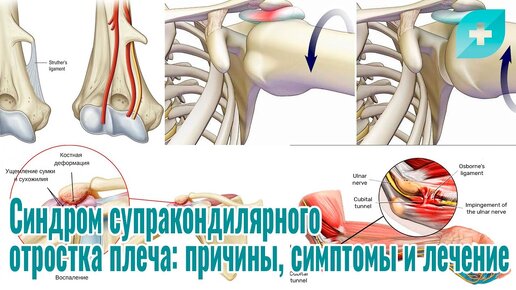 Синдром супракондилярного отростка плеча: причины, симптомы и лечение