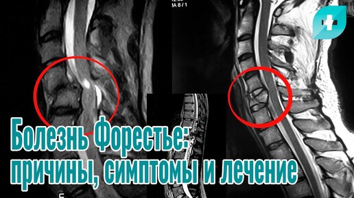 Болезнь Форестье: причины, симптомы и лечение