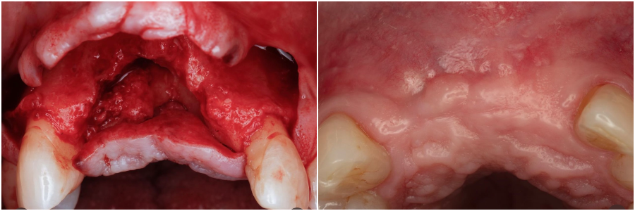НА ФОТО ДО ОПЕРАЦИИ: ОТСУТСВИЕ ЗУБА И ДЕФИЦИТ КОСТИ. НА ФОТО ПОСЛЕ: УСТАНОВЛЕННЫЙ ИМПЛАНТ ПОСЛЕ ПРОЦЕДУРЫ КОСТНАЯ ПЛАСТИКА. 