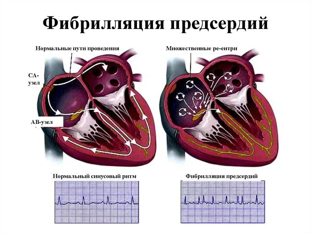 Гипертрофия миокарда левого предсердия на экг. Изменения в предсердиях. Диагноз мерцательная аритмия фибрилляция предсердий. Изменения в предсердиях. Мерцание фибрилляция предсердий на экг.
