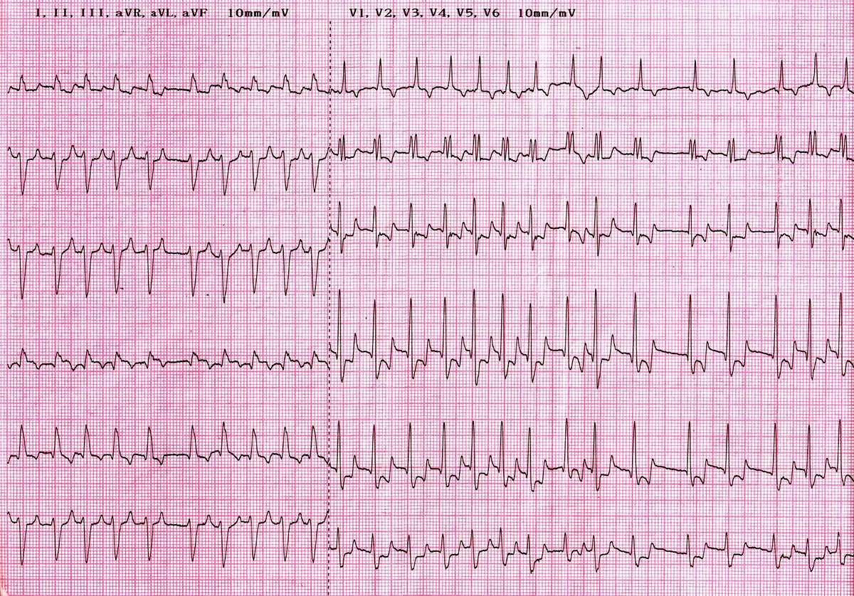 Тахисистолия это. Фибрилляция предсердий на ЭКГ. Фибрилляция предсердий Мерцательная аритмия ЭКГ. Мерцательная аритмия на ЭКГ. Пароксизмальная Мерцательная аритмия ЭКГ.