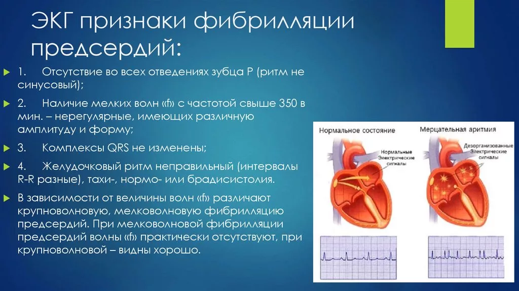 Изменения в предсердиях. Гипертрофия миокарда левых отделов сердца что это. Гипертрофия левого предсердия на экг. Пароксизмальная форма фибрилляции предсердий экг. Изменения в предсердиях.