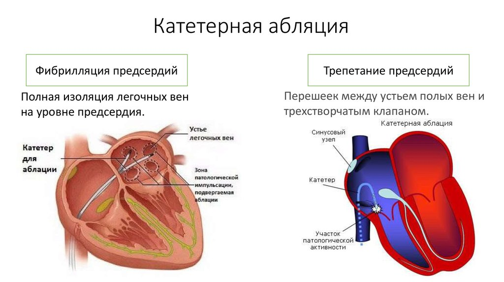 Рча предсердий. Абляция фибрилляции предсердий. Радиочастотная катетерная абляция (РЧА). Изоляция легочных вен при фибрилляции предсердий. Высокочастотная абляция сердца.