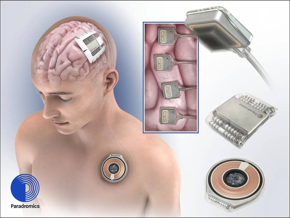 Маск вживил чип в мозг. Чип Нейролинк. Neuralink исследование. Нейролинк имплант. Биохакинг мозга.