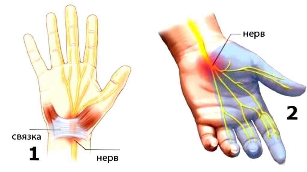 Почему печет рука. Что такое синдром карпального канала на руке?. Карпальный (кистевой) туннельный синдром. Карпальный туннельный синдром рентген. Туннельный синдром пальцев руки.