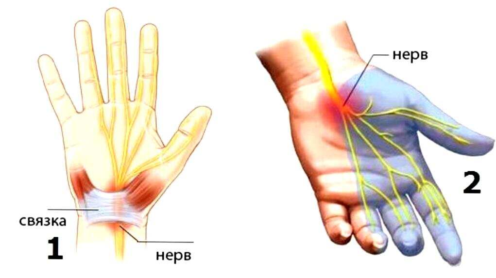 Онемение тканей. Туннельный карпальный синдром руки. Синдром запястного (карпального) канала. Туннельный синдром запястья кисти руки. Туннельный синдром запястья кисти немеет ладонь.