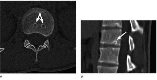 Рис.1. КТ поясничного отдела позвоночника в аксиальной (а) и MPR-реконструкции в сагиттальной плоскости (б). Узлы Шморля. Нарушение целостности замыкательной пластинки тела позвонка.