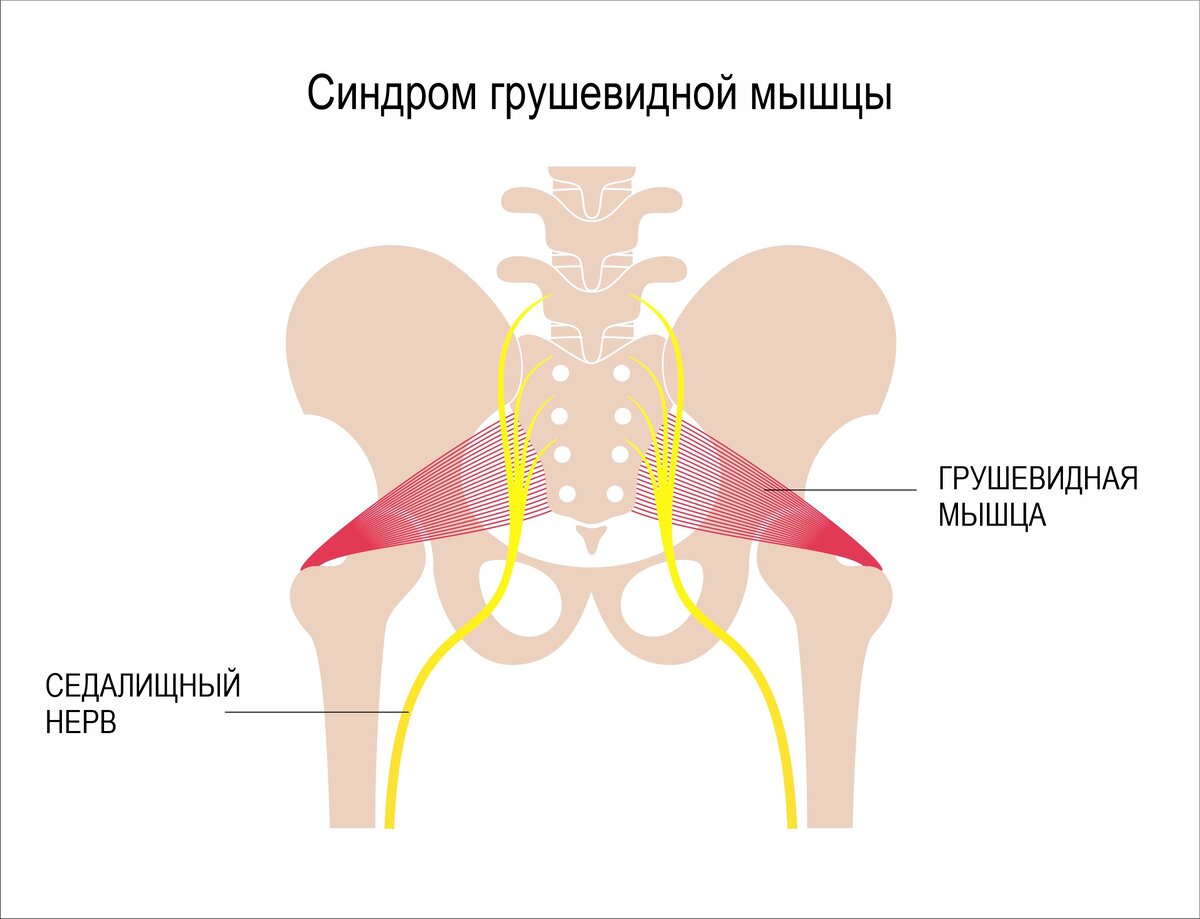 Грушевидная мышца боль в ноге