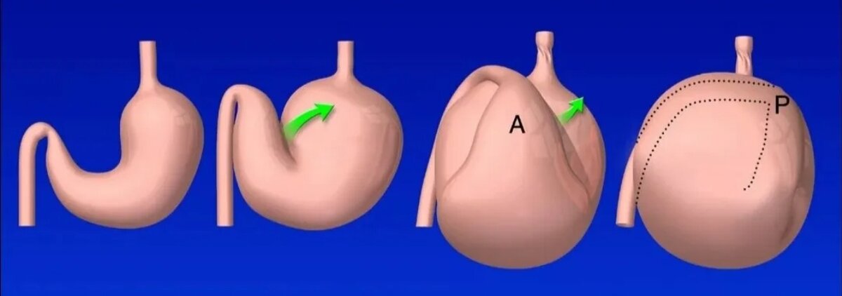 Насколько растягивается. Заворот желудка у человека. Расширение желудка у человека.