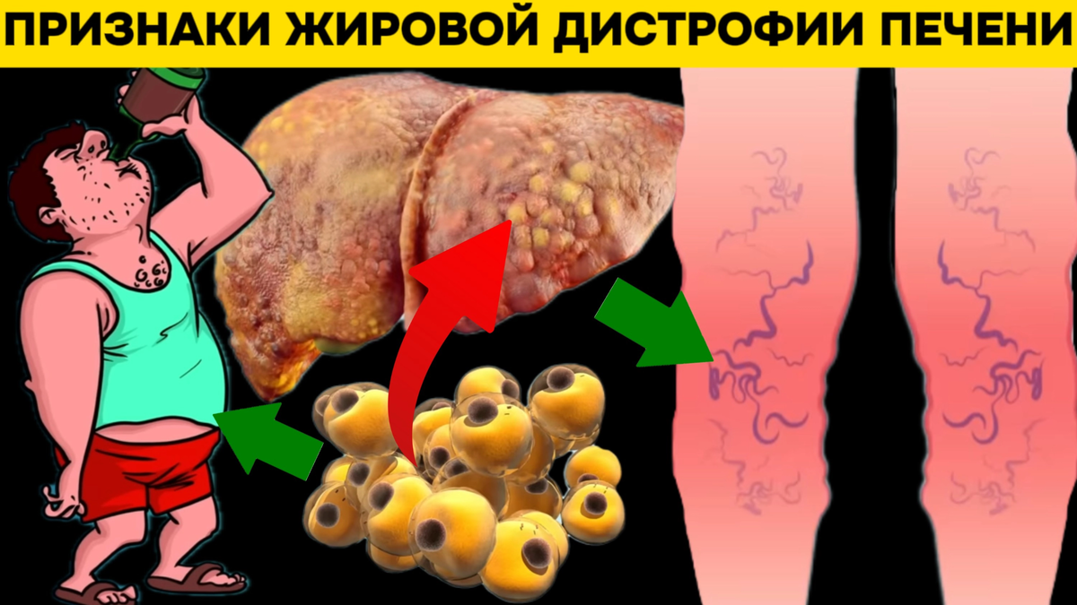 Скрытая угроза: 8 признаков, которые могут указывать на жировую болезнь  печени и что с этим делать | Игорь Ботоговский | Дзен