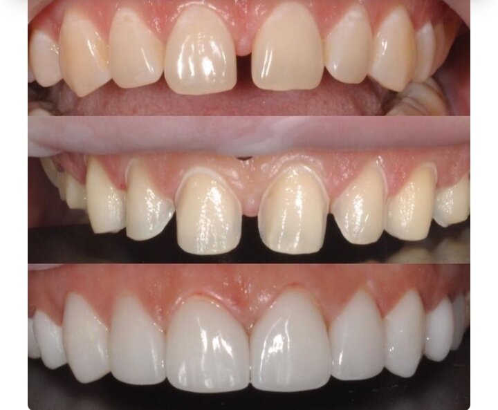 два вторых зуба