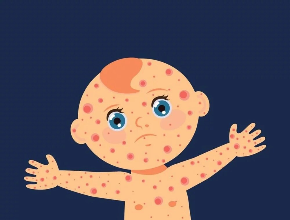 По данным Роспотребнадзора за первые месяцы 2023 года в России зафиксировано больше тысячи случаев кори. Специалисты ВОЗ считают, что заболеваемость корью достигла исторического максимума за последние десять лет [1]. В течение последних трех лет в странах Европы корь стремительно распространятся. В данной статье освещены основные клинические симптомы кори у детей и взрослых.