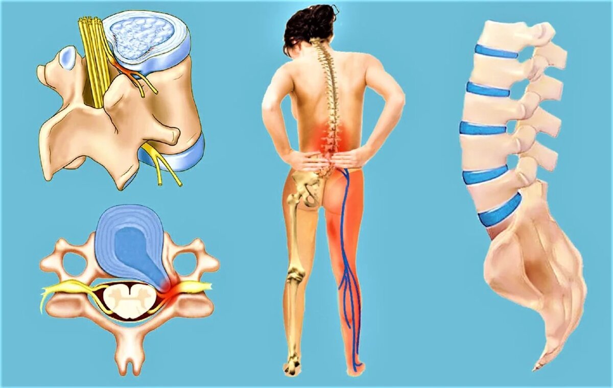 Грыжа позвоночника поясничного отдела. Как вылечить грыжу позвоночника?