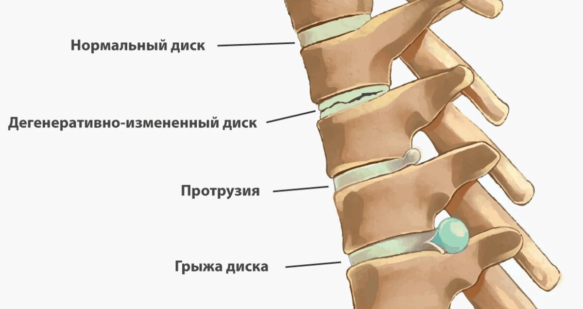 Протрузия дисков позвоночника. Что делать если у вас протрузия дисков?