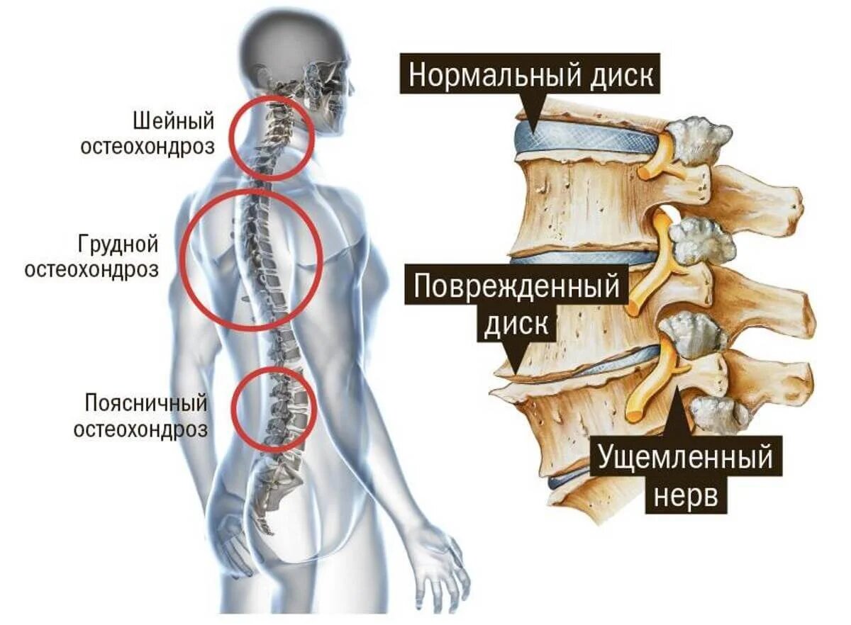 Симптомы остеохондроза позвоночника. Как лечить остеохондроз?