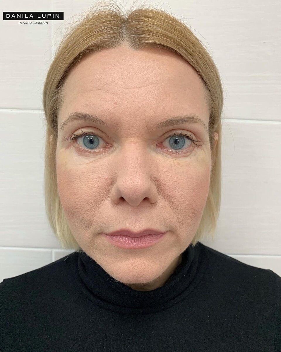 Ортогнатическая хирургия дистальный прикус. Сенюк андрей николаевич. Ортогнатическая операция до и после. Ортогнатическая операция на челюсть. Операция на прикус до и после.