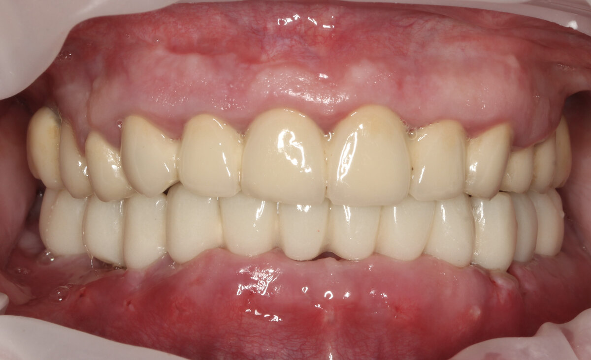 FP1 протез зубов нижней челюсти - временный адаптационный с опорой на 6 имплантатов 