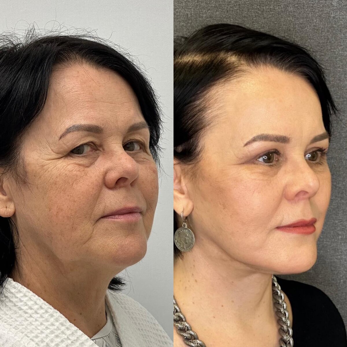 Уколы красоты до и после. Тренировки после ботокса. Ботулинотерапия лица. Ботокс для лица. Тренировки после ботокса.