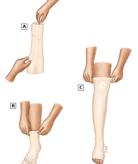 Что такое заболевание вен?