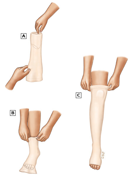Метод надевания компрессионных чулок "карманом на пятке наружу" выглядит следующим образом: 
(A) Переверните часть чулка, предназначенную для ноги, наизнанку до пятки.

(B) Вставьте стопу в чулок, держитесь за сложенный край и потяните чулок на стопу и через пятку.

(C) Аккуратно расправьте чулок вверх по ноге, возвращая его обратно налицо.