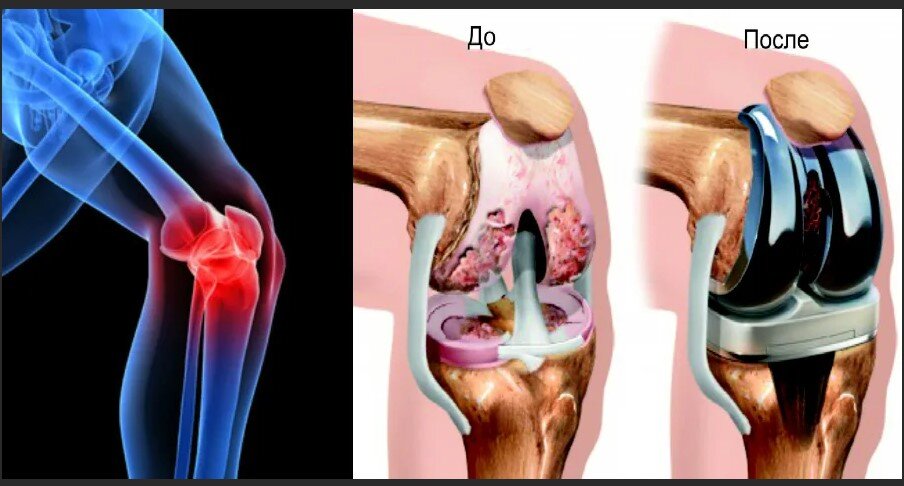 Лучший коленный сустав. Артроз коленного сустава эндопротез. Эндопротезирование коленного сустава операция. Артропластика коленного сустава. Синовиома коленного сустава.