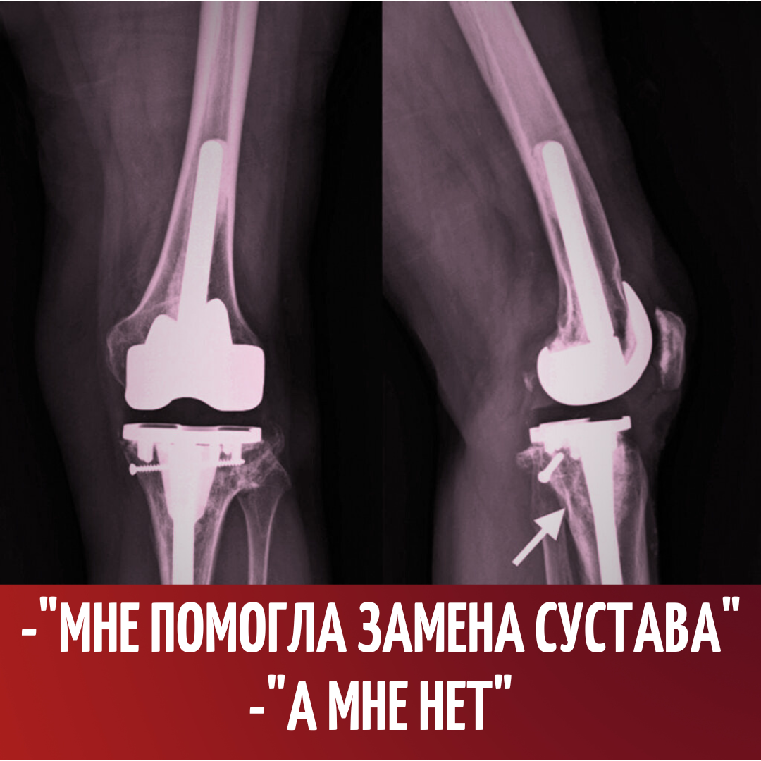 Эндопротезирование коленного сустава реабилитация. Гимнастика после эндопротезирования коленного. Реабилитация после эдопротезироваятазообедреннног сустаава. Замена сустава реабилитаций. Реабилитация после эндопротезирования таз.