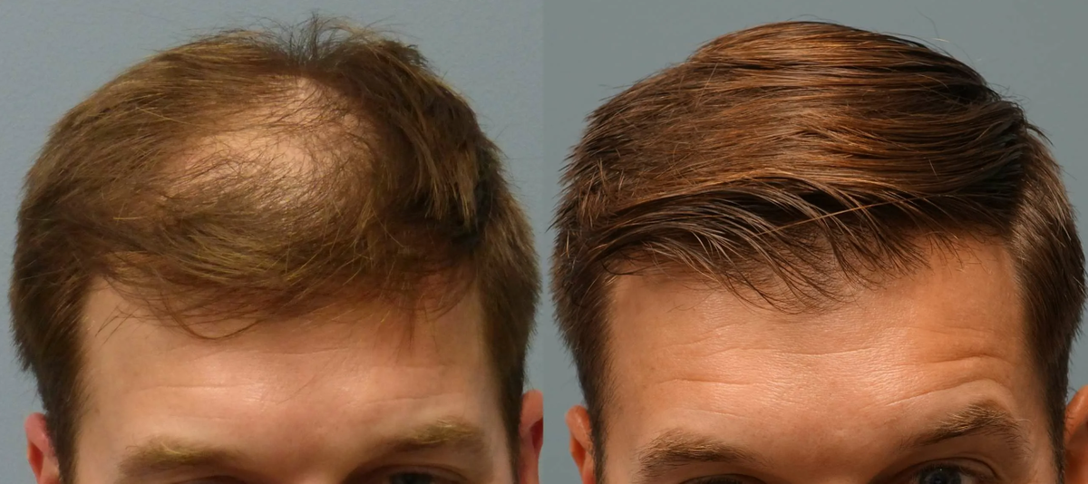 Укрепление волос мужчинам. Мужское тонирование волос. Система волос для мужчин. Трансплантация волос до и после. Протез волос для мужчин.