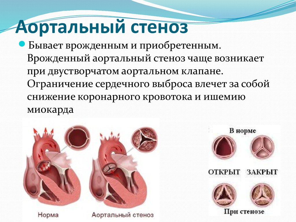 Аортальный стеноз что это такое