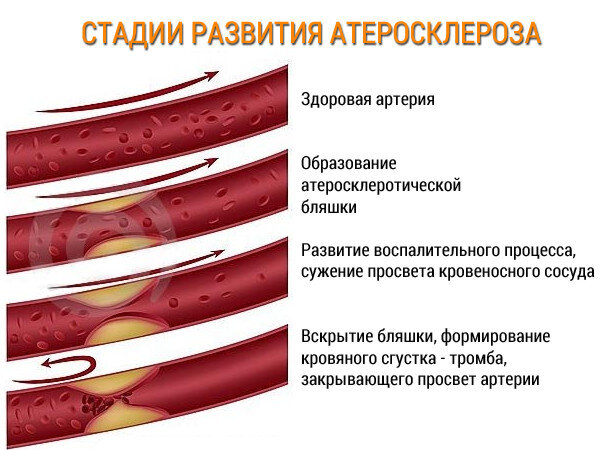 Имбибиция сосудистой стенки