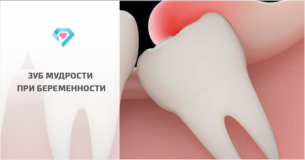 Удаление зуба во время беременности, удаление зуба мудрости при беременности