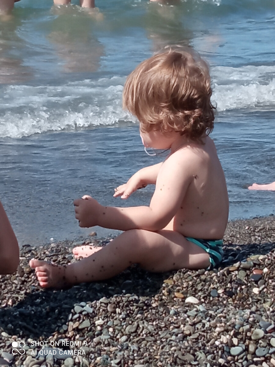 В нашем случае это была долгая медикаментозная кома после операции, проведенной в день рождения киндера - шрам на спине от лапароскопии левого купола диафрагмы..