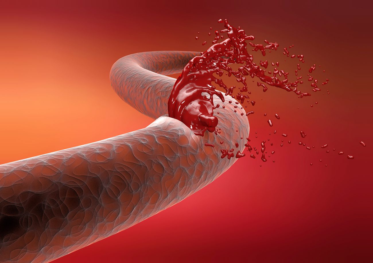 Кровь пои. Повреждение кровеносных сосудов. Кровотечение картинки. Внутренне кровотечение.