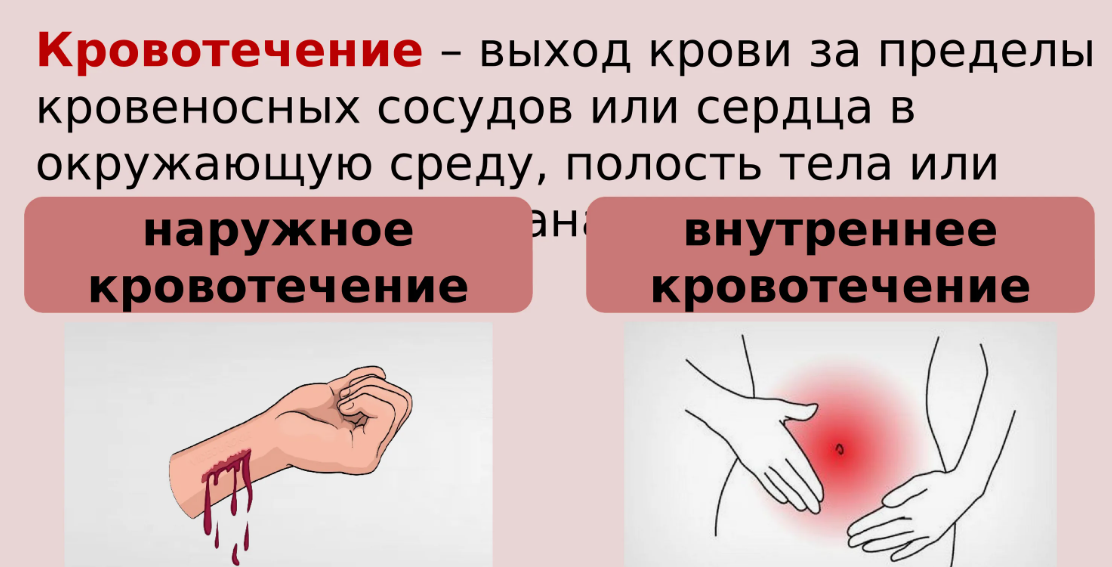 Острое кровотечение тест. Кровотечение картинки. Внутреннее кровотечение картинки. Кровотечение картинки для презентации. Артериальное кровотечение.