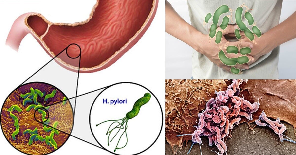 Хилорибактер пилори в желудке. Язвенная болезнь хеликобактер пилори. Хеликобактер пилори язва желудка. Гастрит бактерия Helicobacter. Хеликобактер пилори поражение желудка.