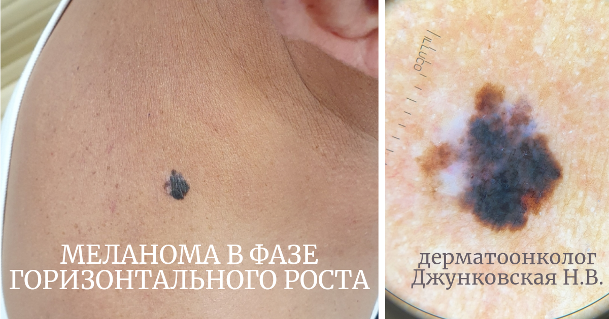 Пациенту уже неоднократно говорили, что это не родинка, а меланома. Но он не верит..., ходит по врачам и собирает мнения.