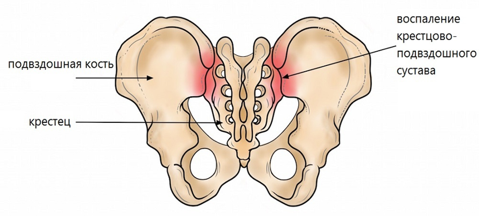 Сустав подвздошной кости. • Сакроилеит (воспаление крестцово-подвздошного сустава). Крестцово подвздошное сочленение болезнь сакроилеит. Двусторонний сакроилеит. КПС сустав крестцово-подвздошный.