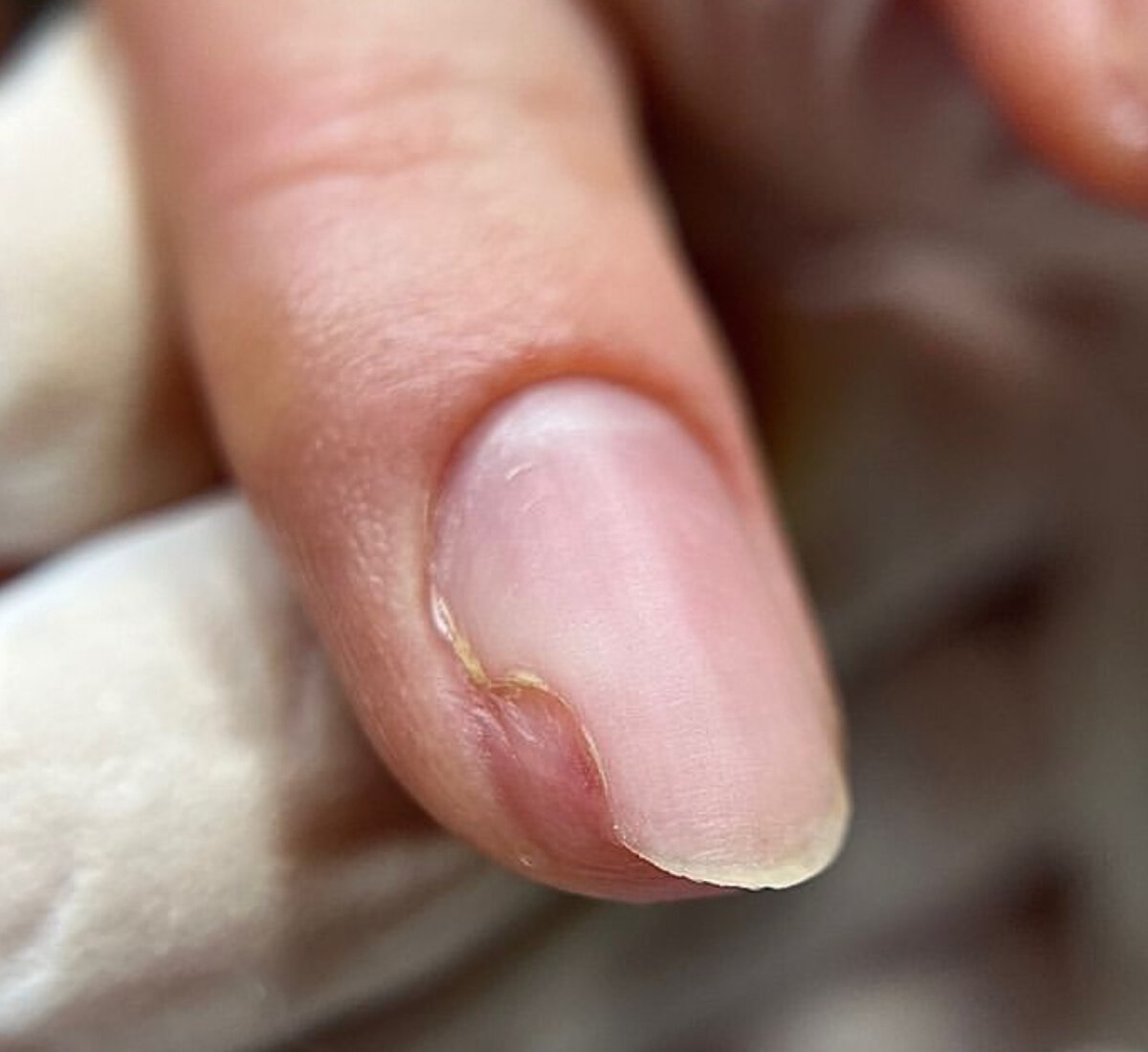 Боковой онихолизис. Очень сложно лечится! В большинстве случаев не проходит до конца и остается навсегда. Выглядит как карман, ногтевая пластина отходит от ногтевого ложа.