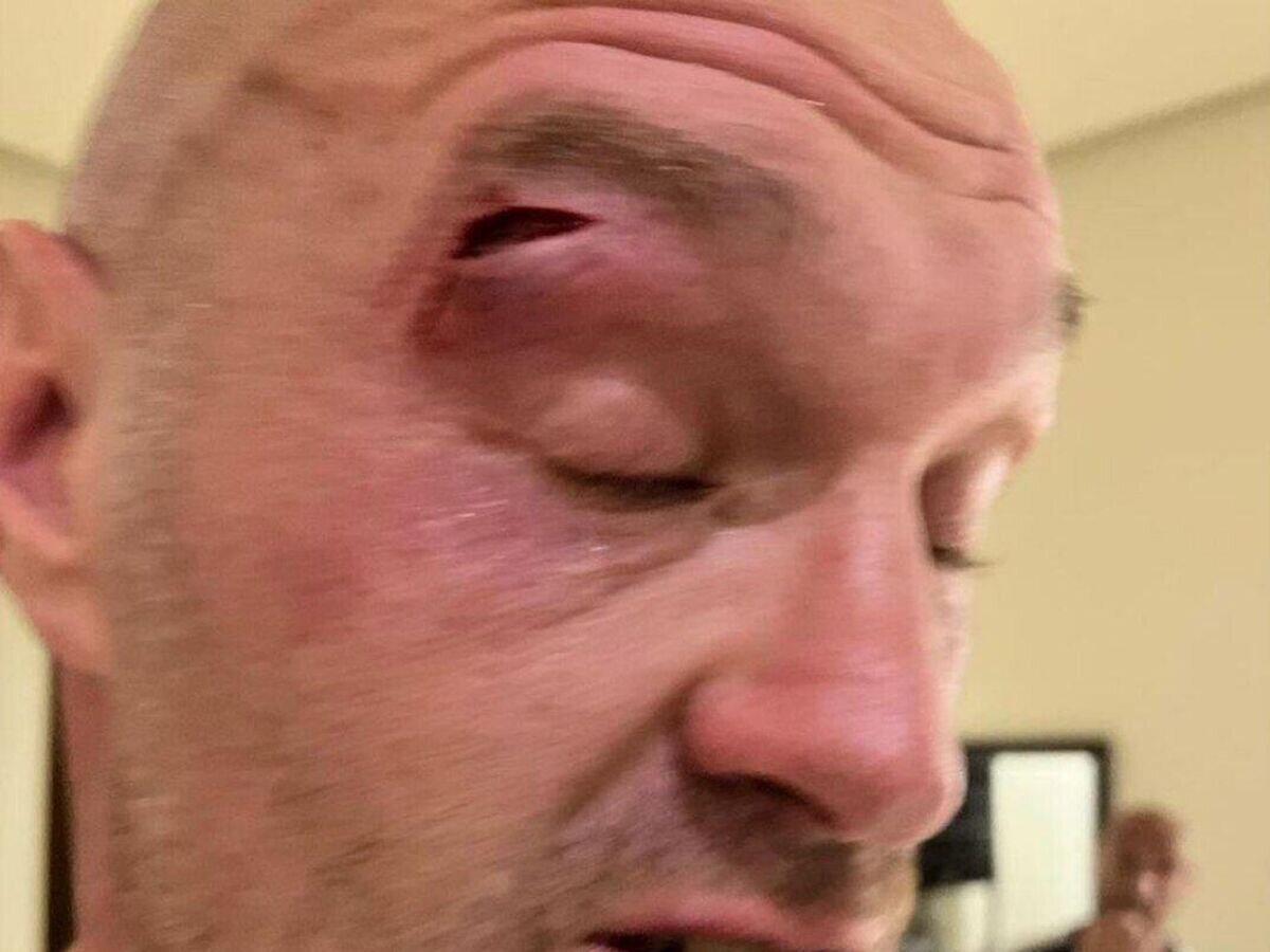    Тайсон Фьюри продемонстрировал рассечение© Фото : Соцсети спортсмена