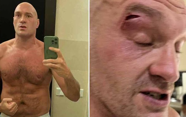 Тайсон Фьюри