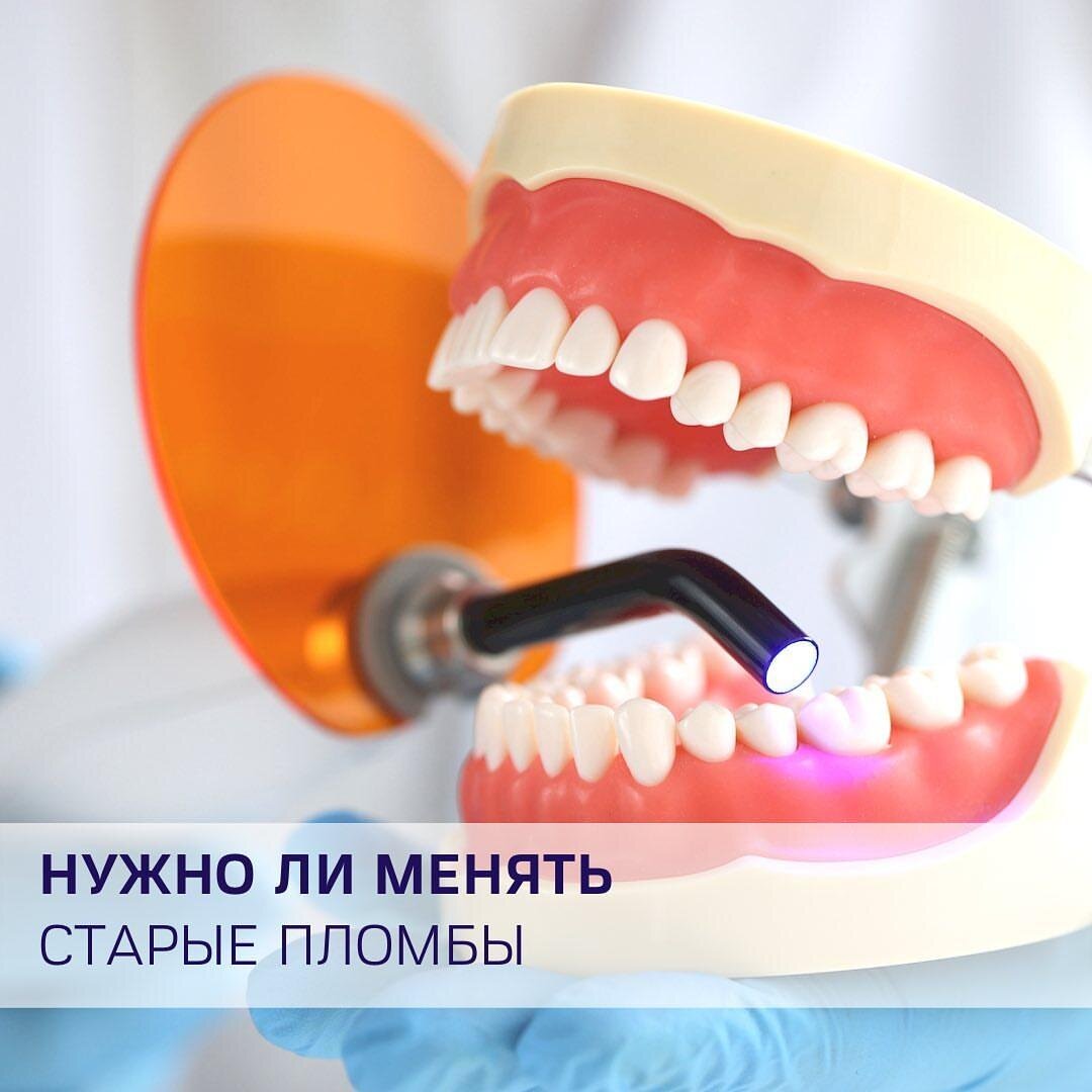 Как пломбируют зубы | этапы, какой материал используется